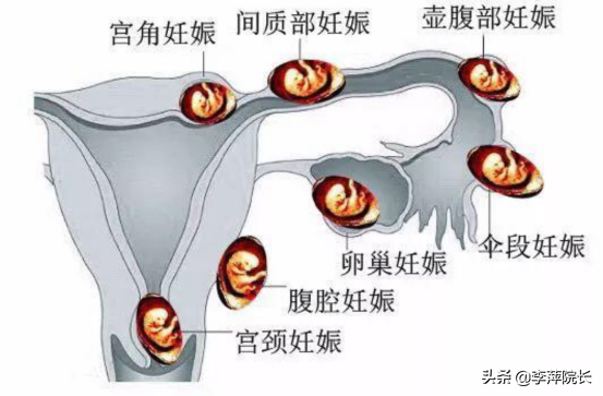 人流后间隔多久怀孕香港验血,真心酸！山东女子1次宫外孕1次胎停2次试管失败