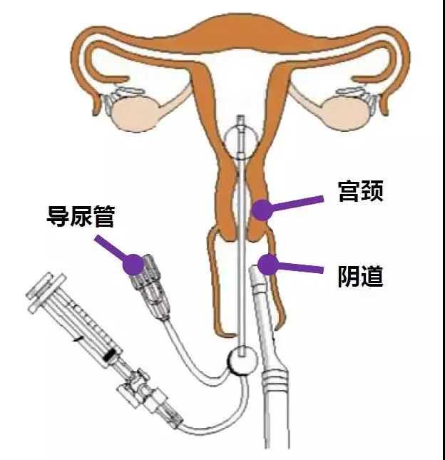 药流两月再次怀孕香港验血准吗,左输卵管通而不畅，右输卵管上举怎么备孕容